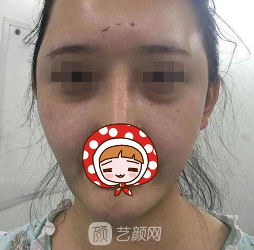 陈银东医生简介|擅长项目+面部脂肪填充实例