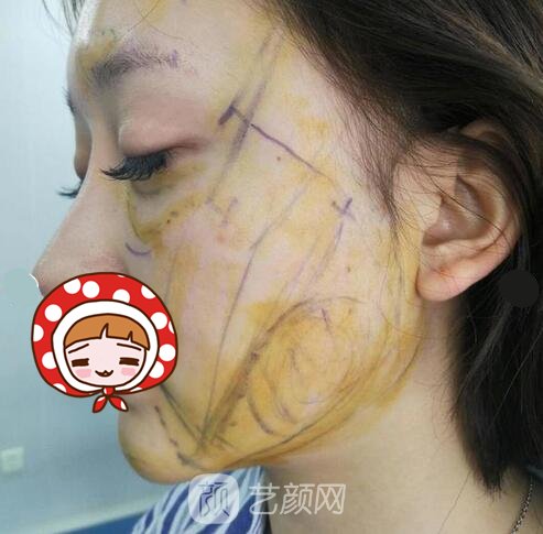 陈银东医生简介|擅长项目+面部脂肪填充实例