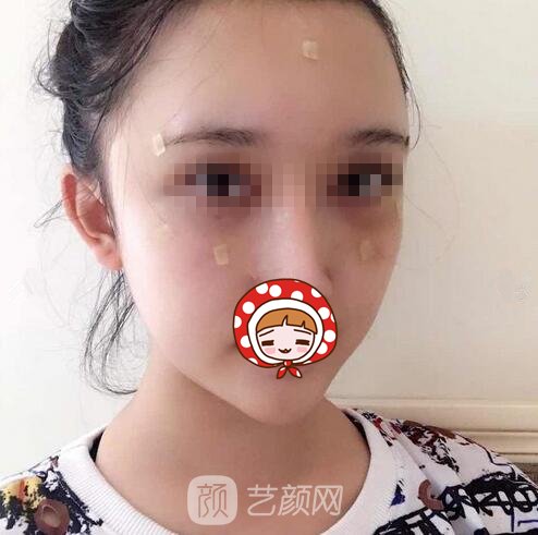 陈银东医生简介|擅长项目+面部脂肪填充实例