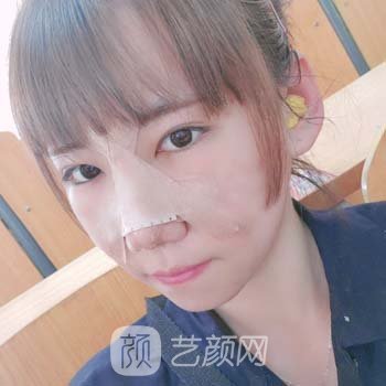 北京美莱王旭东医生做鼻子怎么样？手术风格隆鼻实例