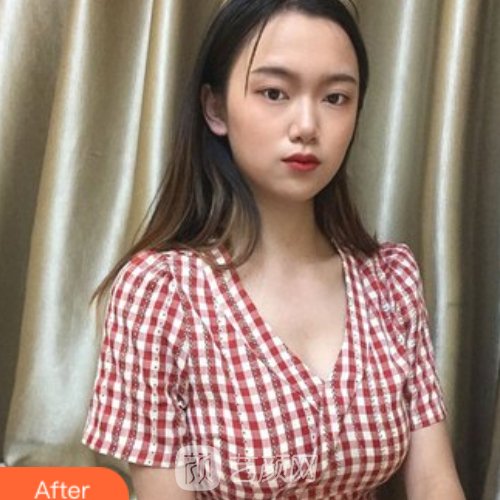 青医附院陈振雨假体丰胸实例公开|内含亲身体验感悟