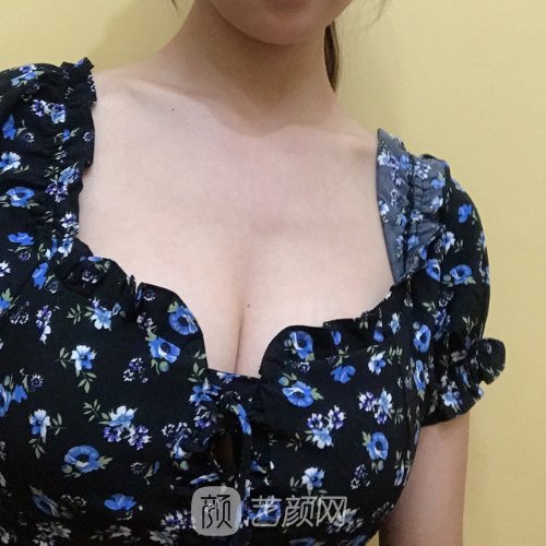 青医附院陈振雨假体丰胸实例公开|内含亲身体验感悟