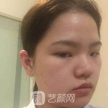 北京八大处整形医院宋涛医生技术怎么样？技术成就+隆鼻实例