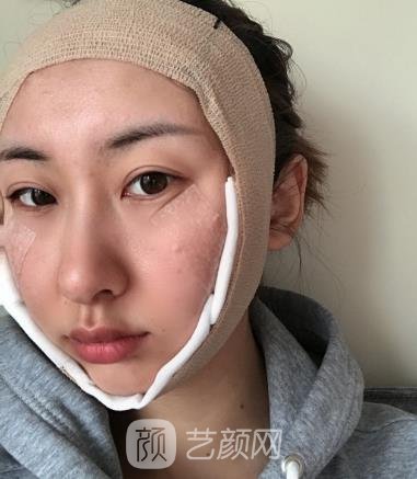 磨颧骨前后对比照，脸变小了之后成为了女神