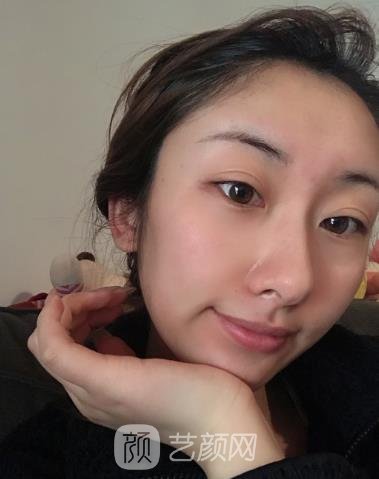 磨颧骨前后对比照，脸变小了之后成为了女神