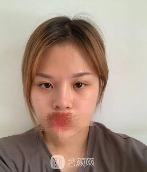 华美美莱杨继红做双眼皮失败实例，修复完成后超惊喜