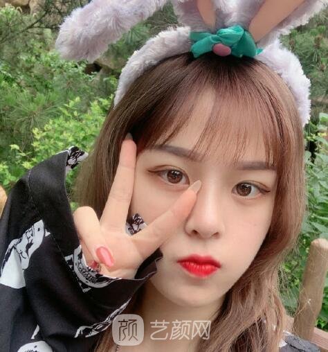 华美美莱杨继红做双眼皮失败实例，修复完成后超惊喜