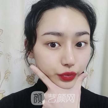 湘雅二医院王先成怎么样？个人简介|出诊时间|隆鼻实例