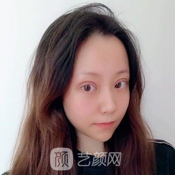 郑州医科大学第三附属医院美容科贾振华双眼皮整形实例，变美图片更新