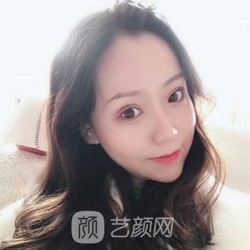 郑州医科大学第三附属医院美容科贾振华双眼皮整形实例，变美图片更新