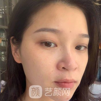 哈尔滨医美张晴激光除皱实例，仿佛回到了18岁