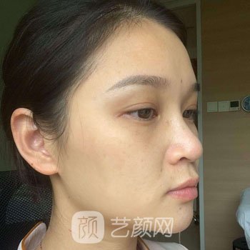哈尔滨医美张晴激光除皱实例，仿佛回到了18岁