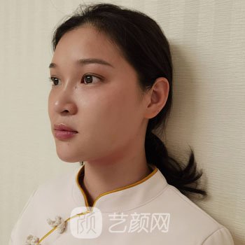 哈尔滨医美张晴激光除皱实例，仿佛回到了18岁