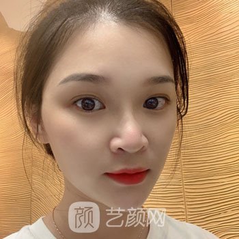 哈尔滨医美张晴激光除皱实例，仿佛回到了18岁