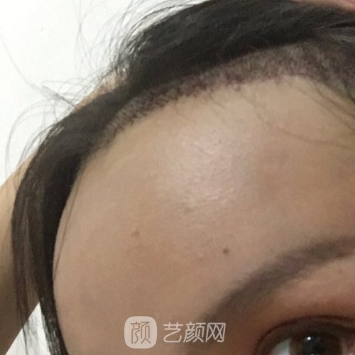 广州熙朵医疗美容医院怎么样？2022植发实例公布