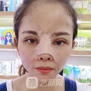 胡华新双眼皮实例，从丑小鸭变成白天鹅的真实经历