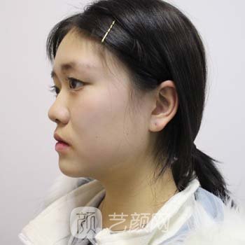 郑颖平双眼皮实例，术后三个月变化超级大，很美哦