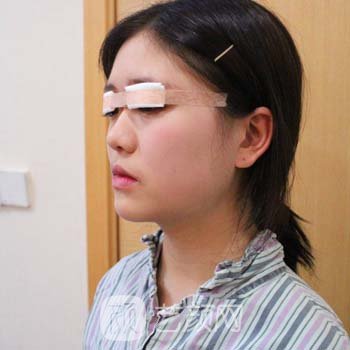 郑颖平双眼皮实例，术后三个月变化超级大，很美哦