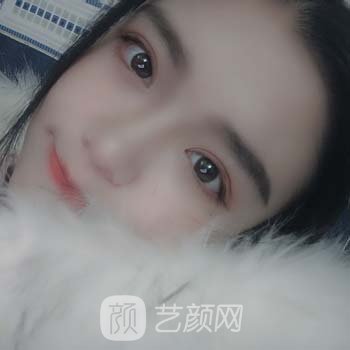 郑颖平双眼皮实例，术后三个月变化超级大，很美哦
