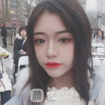 郑颖平双眼皮实例，术后三个月变化超级大，很美哦
