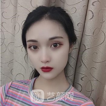 长沙安吉娜做双眼皮怎么样？多少钱？医生介绍+实例图