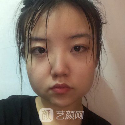 沈阳医大一院下颌角整形实例展示｜附180天修复成果图