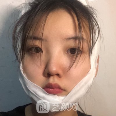 沈阳医大一院下颌角整形实例展示｜附180天修复成果图