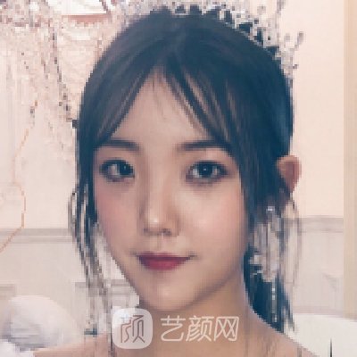 沈阳医大一院下颌角整形实例展示｜附180天修复成果图