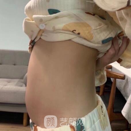 上海第九人民医院吸脂成果如何?2022实例曝光