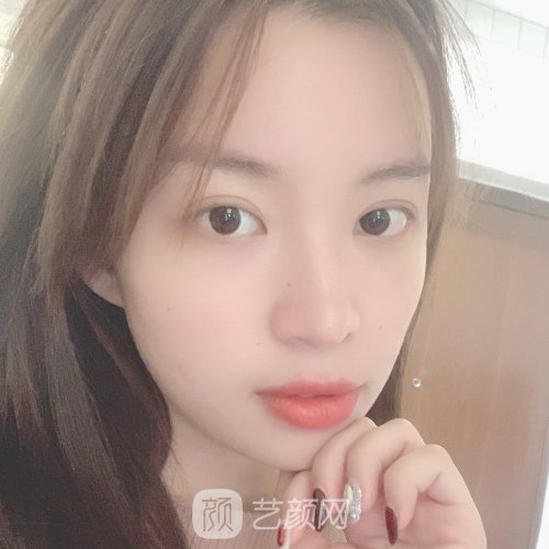 上海九院徐慧医生玻尿酸面部填充实例公开｜附体验对比图