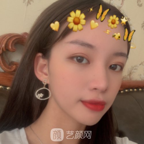 上海九院徐慧医生玻尿酸面部填充实例公开｜附体验对比图