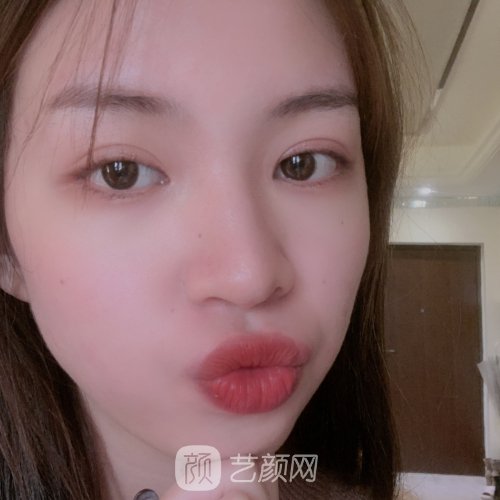 上海九院徐慧医生玻尿酸面部填充实例公开｜附体验对比图