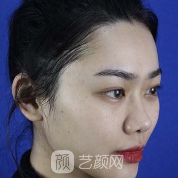 姬广翰个人实例，硅胶隆鼻前后对比图片鉴赏