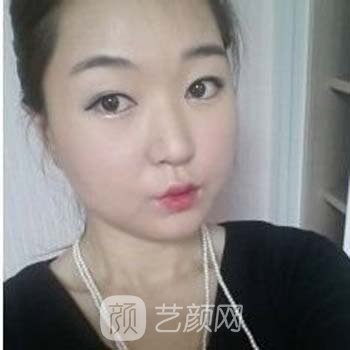 上海曹栋弼技术怎样？医生简介+下颌角磨骨真人实例更新