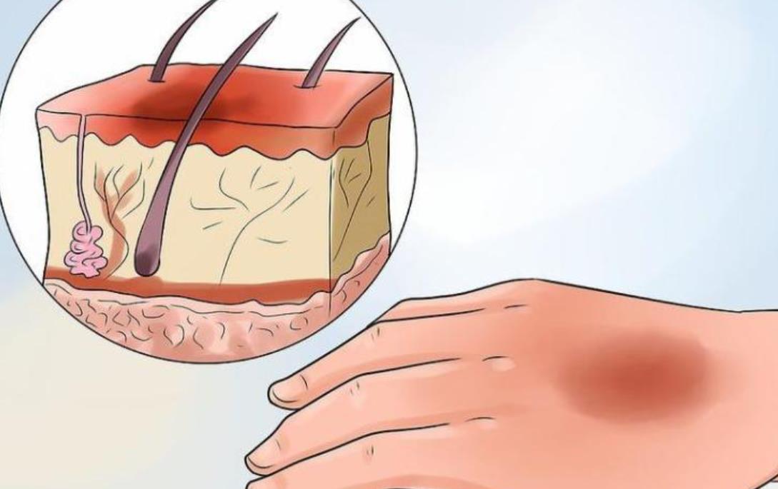 疤痕hg4.jpg 疤痕hg4.jpg