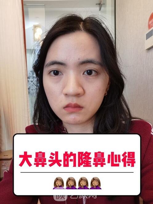 鼻翼缩小手术对比效果图,120天案例鉴赏,超惊艳