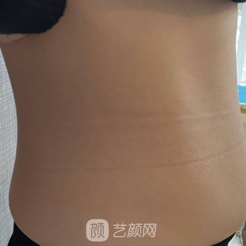 齐鲁医院抽脂好不好？亲身体验前后成果图出炉
