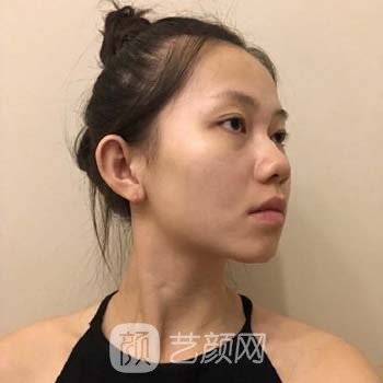 西京孙峰隆鼻专辑案例，手术效果令人意外，绝美