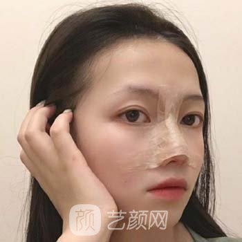 西京孙峰隆鼻专辑案例，手术效果令人意外，绝美