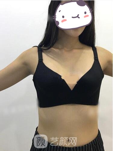 重庆美仑美奂隆胸失败修复实例，采用自体脂肪填充来修复