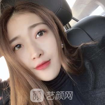 王军隆鼻失败修复实例，修复之后鼻子变得迷人又精致