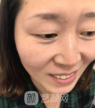 卢丙仑做拉皮手术好吗？在哪家医院？医生介绍+拉皮除皱实例