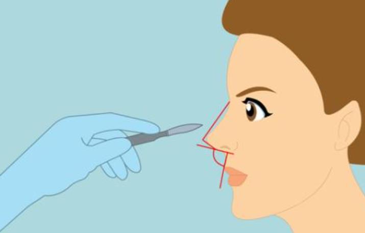 鼻综合3.jpg 鼻综合3.jpg