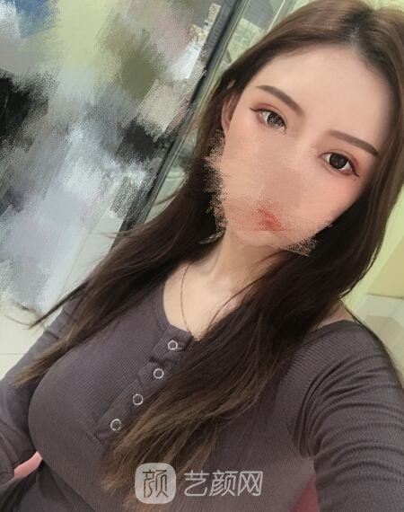 常维国隆胸实例，胸部变得挺拔有形，手感还很柔软