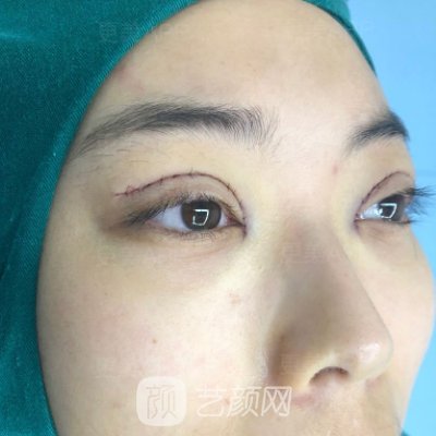 北京医院双眼皮价目表更新|内含医院招牌实例