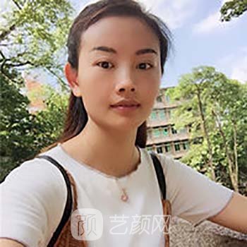 曹卫刚做的脂肪填充怎么样？真人实例分享，拥有少女面容