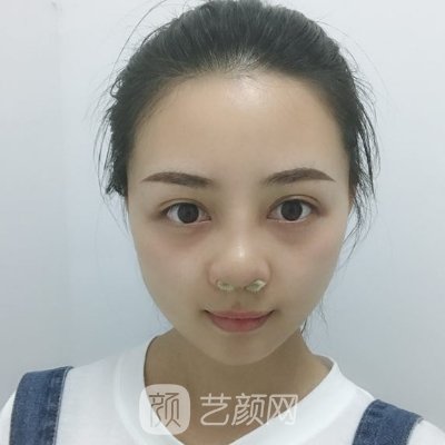 贵阳利美康整形美容医院隆鼻实例展示|成果自然美观