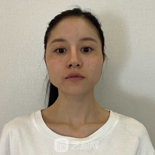 北京301医院削骨磨腮案例展示|内含亲身体验案例