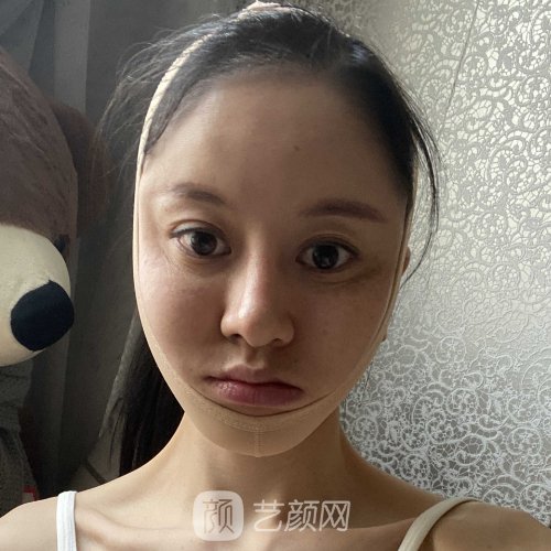 北京301医院削骨磨腮实例展示|内含亲身体验实例
