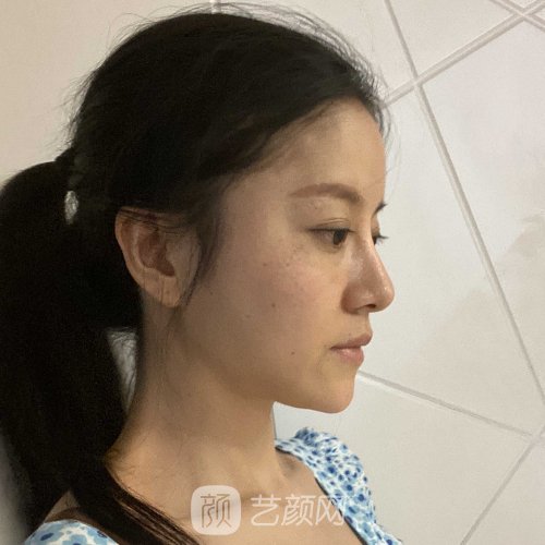 北京301医院削骨磨腮案例展示|内含亲身体验案例